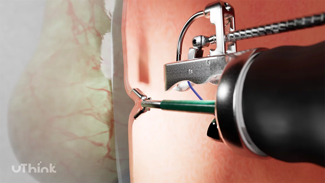 ESG_Grasper_Still_628p